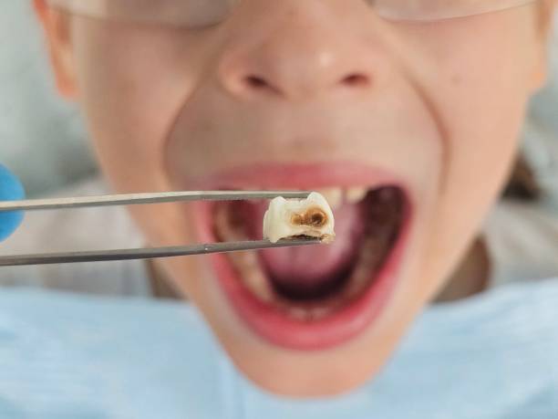 Best Emergency Dental Extractions in South Beloit, IL